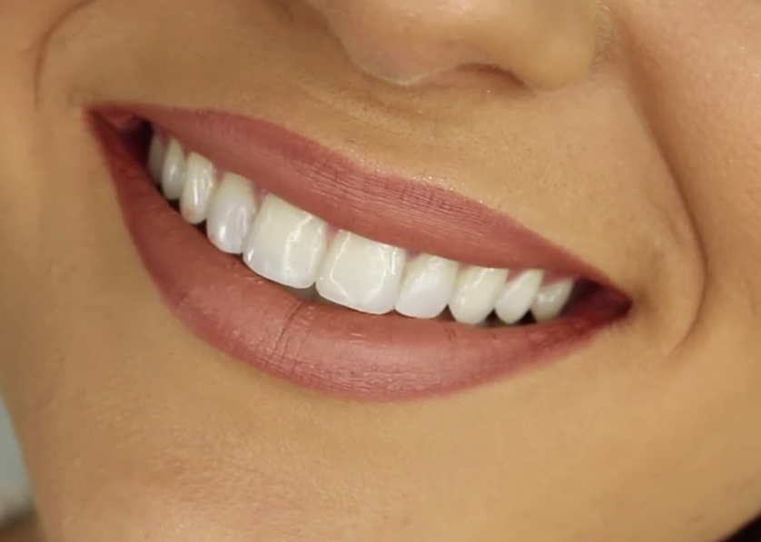 Reclaim Your Radiant Smile: Tips to Prevent Tooth Staining and Discoloration with Mall of Georgia Dentistry